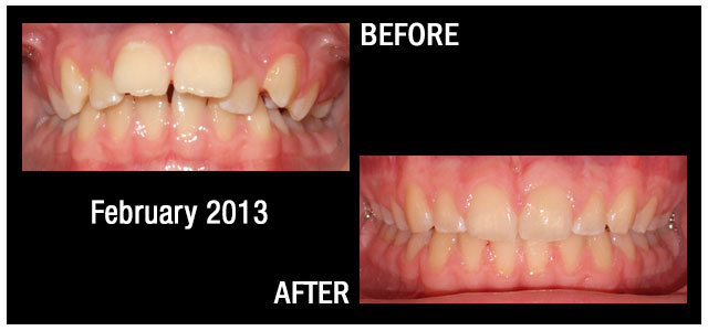 Results from Braces February 2013 Hampstead NC
