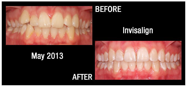 Results from Braces May 2013 Hampstead NC