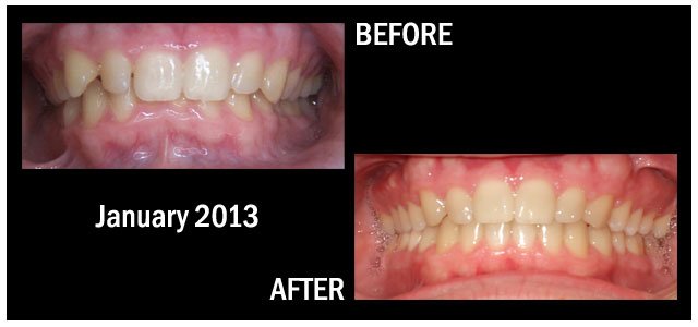 Results from Braces January 2013 Hampstead NC
