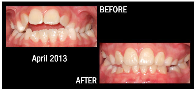 Results from Braces April 2013 Hampstead NC