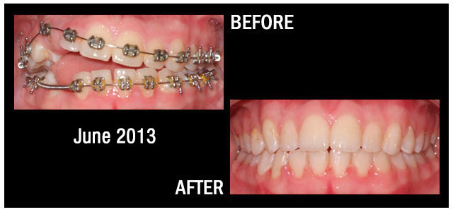 Results from Braces June 2013 Hampstead NC