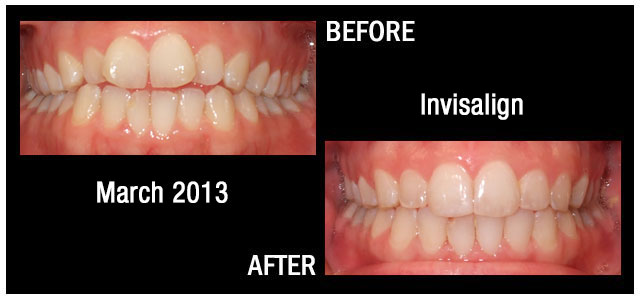 Results from Braces March 2013 Hampstead NC